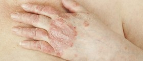 Link Between Psoriasis And Hypertension
