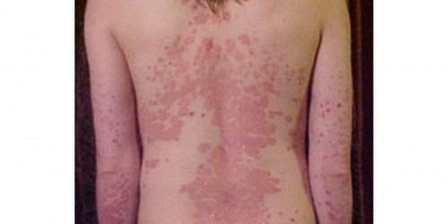 Biologics - New Treatment Hope For Psoriasis Sufferers