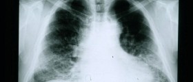 Four Lung Diseases You May Not Be Aware Of