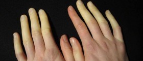 Raynaud's phenomenon