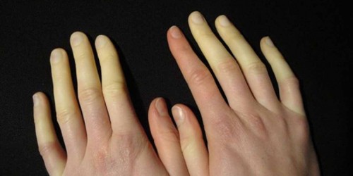 Raynaud's phenomenon