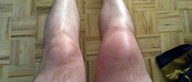 Reactive Arthritis: What Is It And How Can It Be Treated?