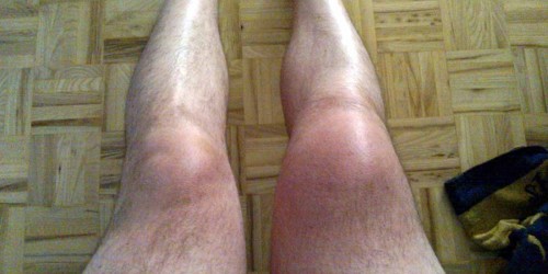 Reactive Arthritis: What Is It And How Can It Be Treated?