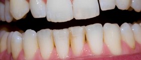 Why Do Gums Recede?