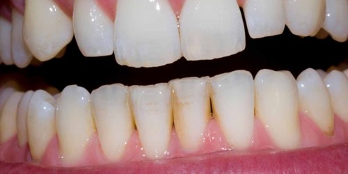 Why Do Gums Recede?