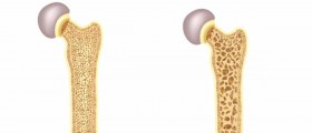 Recognizing The Early Warning Signs Of Osteoporosis