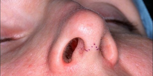 What You Should Know About Recovering from Rhinoplasty