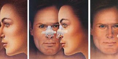 Rhinoplasty: Post operative consequences