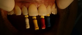 Why Do Some Root Canal Treatments Fail Over Time?