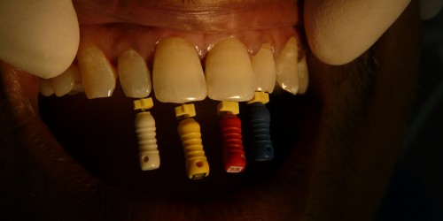 Why Do Some Root Canal Treatments Fail Over Time?