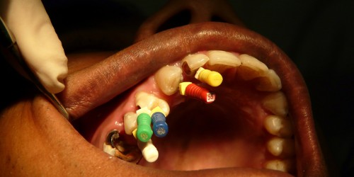 Root Canal Treatment: No Longer The Stuff Of Nightmares