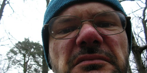 Rosacea Skin - Best 6 Tips to Cure You