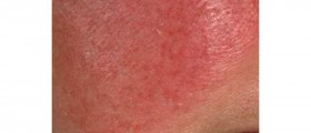 Rosacea: Symptoms & treatment