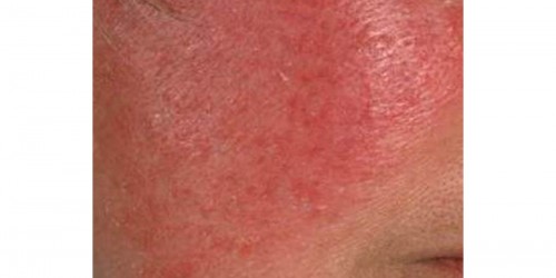 Rosacea: Symptoms & treatment