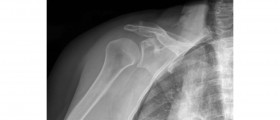 Rotator Cuff Problems: Frozen Shoulder