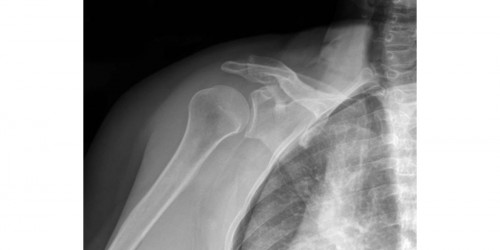 Rotator Cuff Problems: Frozen Shoulder