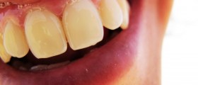 Excessive Salivation: Causes And Management