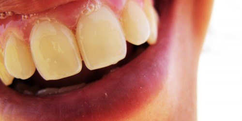 Excessive Salivation: Causes And Management