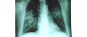 Sarcoidosis Treatment