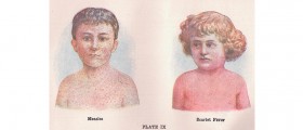 Scarlet Fever in Children