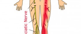 Treatment For Sciatic Nerve Pain