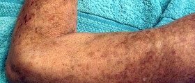 Scleroderma: An Overview