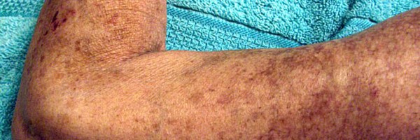 Scleroderma: An Overview