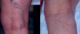 Sclerotherapy: Spider Vein Treatment