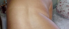 Scoliosis treatment