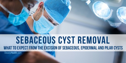 Sebaceous Cyst Removal: What To Expect From The Excision Of Sebaceous, Epidermal And Pilar Cysts