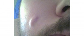 Sebaceous Cysts: Treatment for Facial Cysts