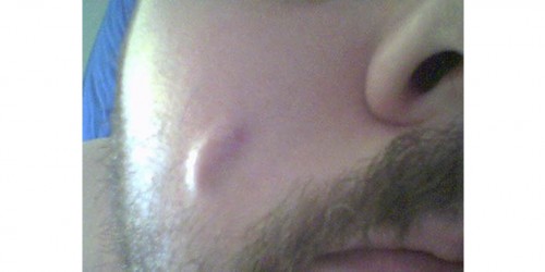 Sebaceous Cysts: Treatment for Facial Cysts