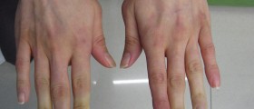 Cold Hands: Raynaud's Disease