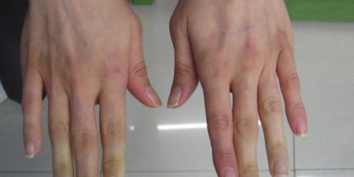 Cold Hands: Raynaud's Disease