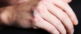 Natural Treatments for Psoriasis