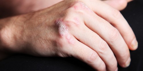 Natural Treatments for Psoriasis