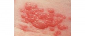 Shingles & Stress