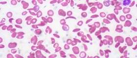 Sickle Cell Anemia: Symptoms, Diagnosis And Treatment