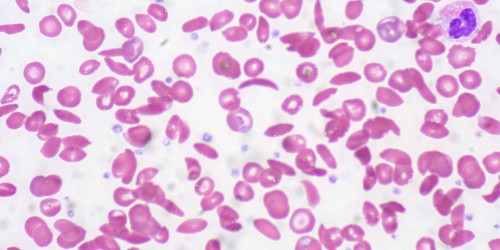 Sickle Cell Anemia: Symptoms, Diagnosis And Treatment