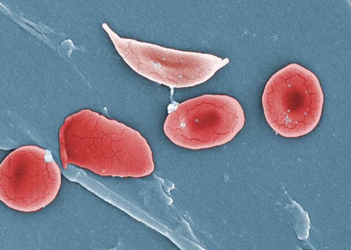 Hope for a Cure: Sickle Cell Disease | Cardiovascular Disorders and