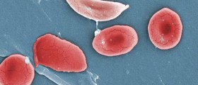 Hope for a Cure: Sickle Cell Disease