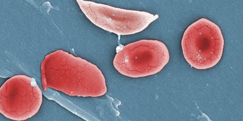 Hope for a Cure: Sickle Cell Disease