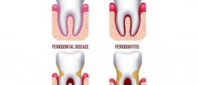 Signs of Gum Disease: Gingivitis vs Periodontitis vs Advanced Periodontitis