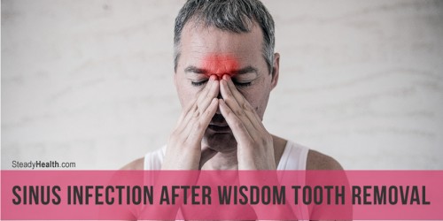 Sinus Infection After Wisdom Tooth Removal