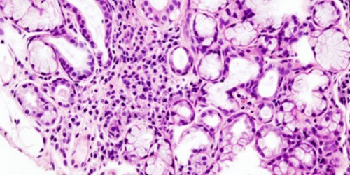 Sjogren s Syndrome: Causes & Symptoms