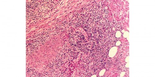 Sjogren's syndrome: Causes, Symptoms & Treatment