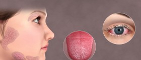 Sjogren's syndrome fact sheet