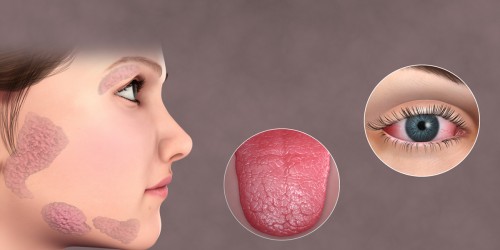 Sjogren's syndrome fact sheet