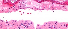 Stevens Johnson syndrome (SJS): Symptoms & Treatment