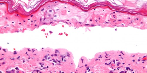 Stevens Johnson syndrome (SJS): Symptoms & Treatment